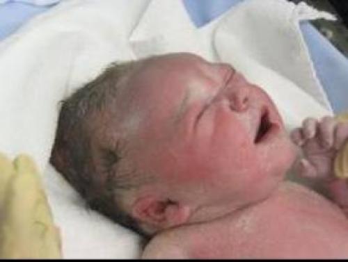 طفل أميركي يولد من دون جلد يغطي جسده Image