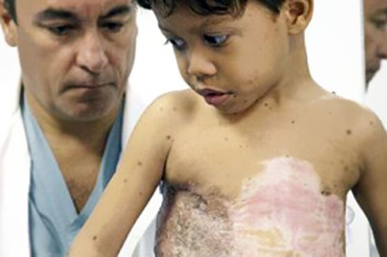 جراحة رائدة تخلص طفلا كولومبيا من لقب "السلحفاة" - صور
